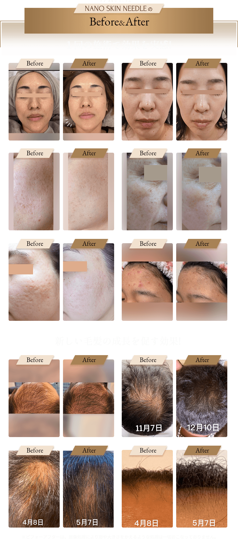 ビフォーアフター1回の施術で美白に、ほうれい線が薄くなっている