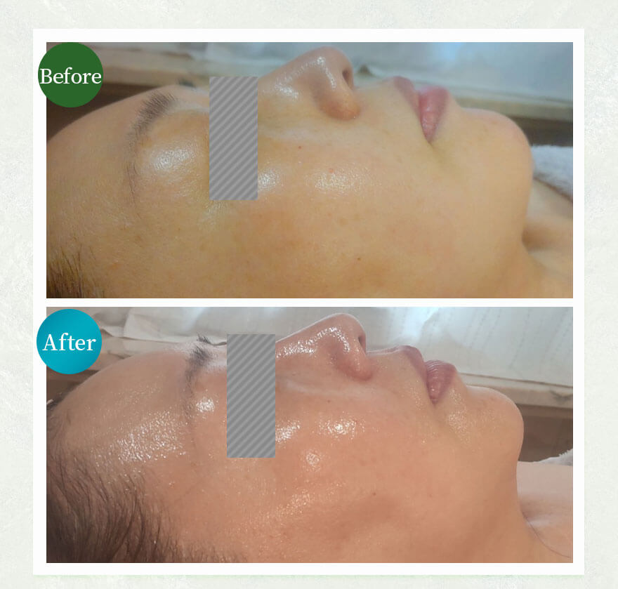 7日〜14日の間隔で3〜5回の施術を推奨