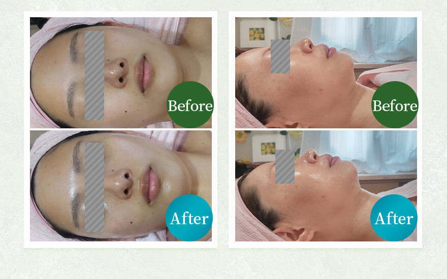 ビフォーアフター写真